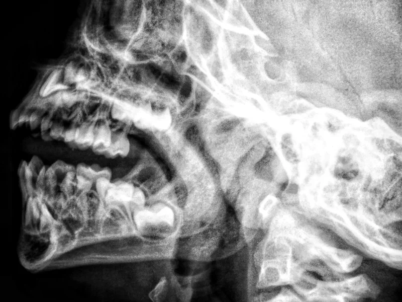How X-Rays works at Camel City Chiropractic