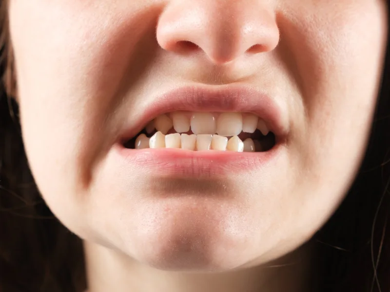 How Camel City Chiropractic treats tmd / tmj in Winston-Salem
